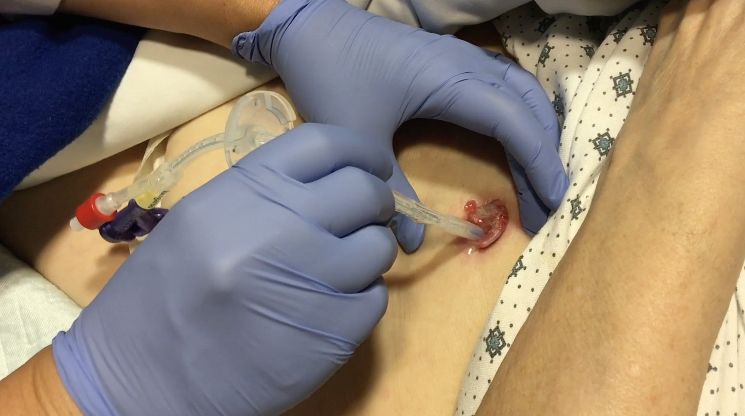 Gastrostomy tube replacement and removal