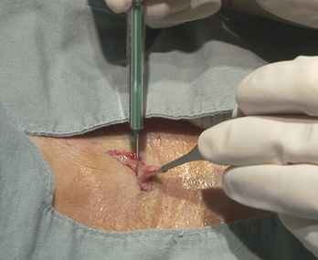 Excision and biopsy of lesions