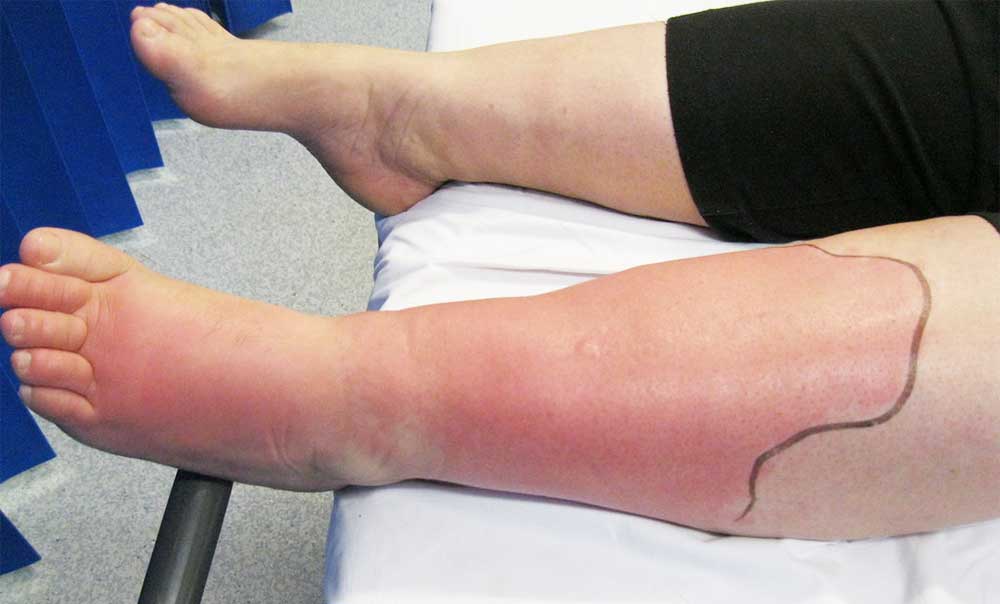 Cellulitis and infection treatment